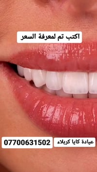 كربلاء شارع الاسكان • حشوة جذر جلسة واحدة • فحص مجاني مع ضمان