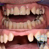 طقم جزئي متحرك • مجانا • باب المعظم