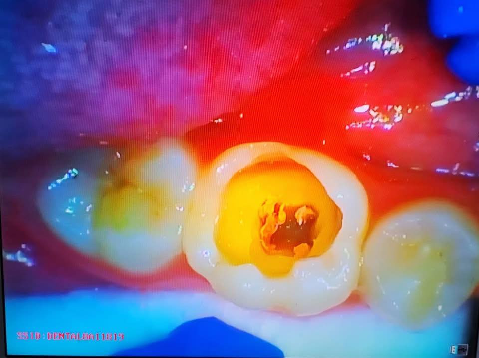 حشوة جذر للسن الخلفي
طبيب الاسنان الاختصاص د.عمار عباس
ماجستير تقويم وتجميل الاسنان M.S.c ortho
بكلوريوس طب وجراحة الفم والأسنان B.D.S
بغداد الشعب شارع عدن قرب  مركز شرطة الشعب  مدخل سوق شلال عمارة باريس الطابق الاول دوام العيادة جميع ايام الاسبوع ما عدا الجمعة عطلة من ٤ ل ٨  بدون حجز مسبق الدخول حسب اسبقية الحضور للعيادة الفحص والمعاينة مجاني للاستفسار ***********
