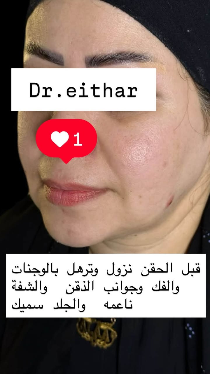 تجديد استداره وجه كامله بطريقة الشد بالفلر (لفتنك وجنات واصداغ  الفك والذقن  ونظاره  فلر شفة بالفلر الكوري)

عروض  خصم التغيير الشامل وجلسات الشد والنظاره    مستمره🔥🔥دزو نقطه توصلكم العروض

د.ايثار سامي عبد الامير
الكوت_واسط _الهوره_مجمع القبطان

الحجز***********
