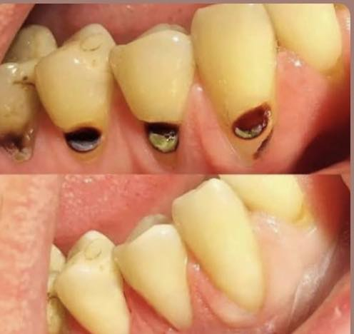 السلام عليكم
الي عنده بقايا جذور اسنان او اسنان تالفة محتاجة قلع

او تنظيف اسنان او حشوات ضوئية تجميلية 

مثل الحالات الي بالصوره 

يكدر يتواصل وياي على الواتساب ***********

 ونحدد موعد الشغل 

العنوان الحلة شارع اربعين مجاور صيدلية سلامتك اولاً
