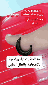 العنوان محافظة واسط قضاء النعمانية شارع 13 مجمع حامد طبره الطابق الثاني يوجد كادر نسائي للنساء 
***********
 مع مراعاة أقصى درجات النظافة و التـعقيم لضمان سلامـة
📌 فوائد معالجة الإصابات الرياضية بالعلق الطبي
العلاج بالعلق الطبي يُعدّ أحد الأساليب المساعدة في حالات معيّنة من الإصابات الرياضية، خاصة تلك التي يصاحبها احتقان أو تورّم طويل. عند وضع العلق على المنطقة المصابة، يقوم بإفراز مواد فعّالة تعمل على تنشيط الدورة الدموية، تقليل الالتهاب، تخفيف الألم، وسحب الاحتقان الدموي العميق. هذا يساعد على تسريع شفاء بعض الكدمات والإصابات التي لا تستجيب للعلاج التقليدي بسرعة.
ورغم فوائده، 
 #الجميع #اشارة #متابعين 
#العلق_الطبي #العلاج_بالعلق #إصابات_رياضية #العلاج_الطبيعي #الكدمات #تورم #شفاء #صحة #طب_بديل
