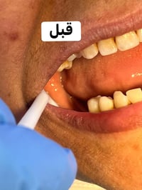 رجعت انفتحت الحجوزات عند الدكتورة تبارك المشعان  لتعويض الاسنان المفقو...