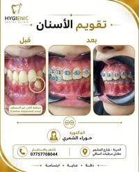 خلال مرحلة تقويم الاسنان لتعديل الاسنان المتراكبه   الناب المرتفع أو غ...