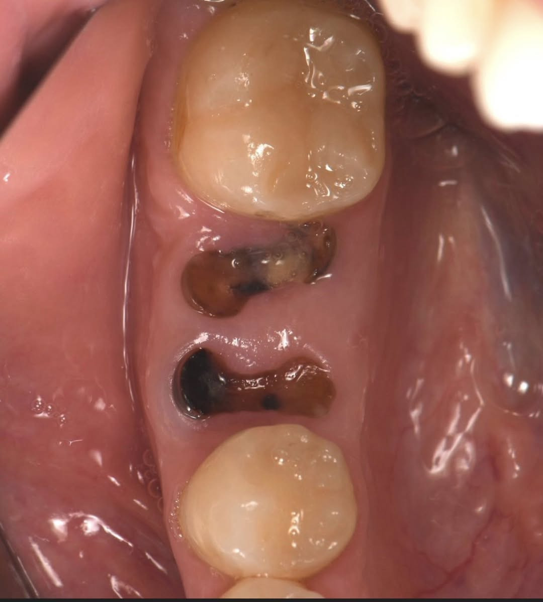 السلام عليكم اي شخص عنده مثل هذني الحالات ويحتاج علاج يتواصل وياي العلاج مجاناً  ✅قلع او تنظيف او حشوات 
***********
