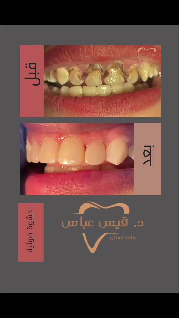 حالة تسوس شديد في الأسنان الأمامية
تم علاجها وإعادة الشكل الطبيعي للأسنان باستخدام حشوات تجميلية (Composite) للحصول على ابتسامة أجمل ووظيفة أفضل.

📍 عيادة د. قيس عباس الساعدي
بغداد – حي الجهاد – الشارع التجاري
📞 ***********
#دقيس_عباس_الساعدي #حشوة_ضوئية #بغداد #BeforeAfter #viral
