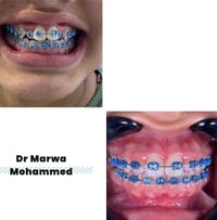 تقويم الأسنان  د. مروة محمد طالب  للتواصل ع الرقم 07718256909