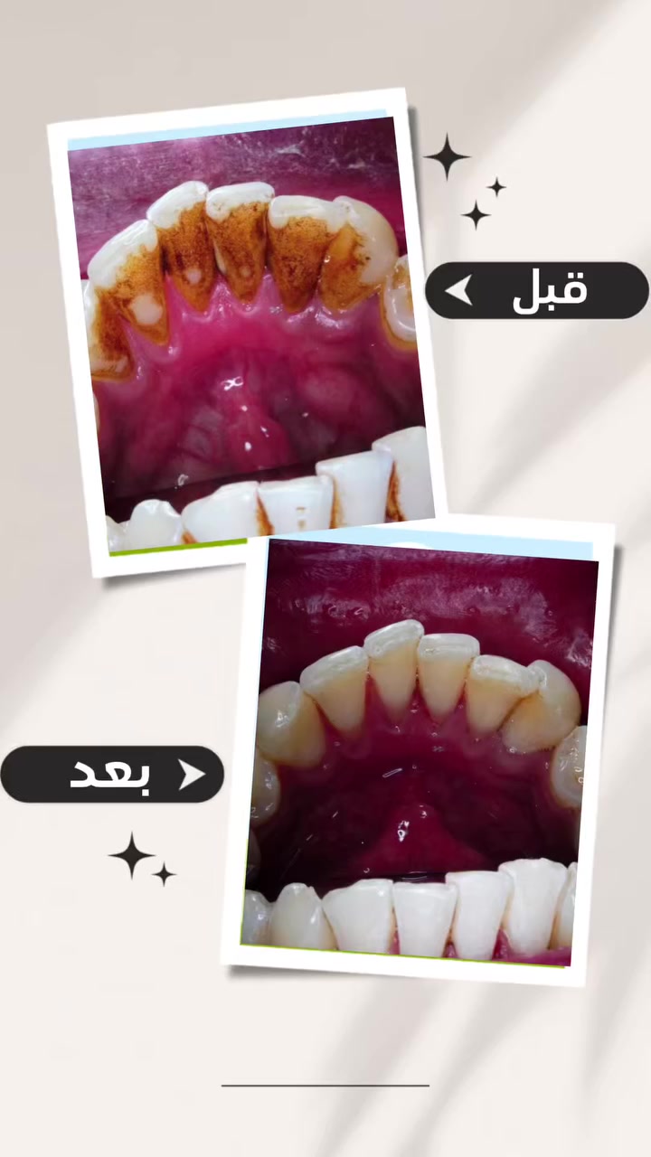 تنظيف الاسنان في عيادتنا ب ٢٠ الف فقط
تنظيف مع تبييض الاسنان ب ٨٠ الف فقط 

للحجز والاستسفار ***********
