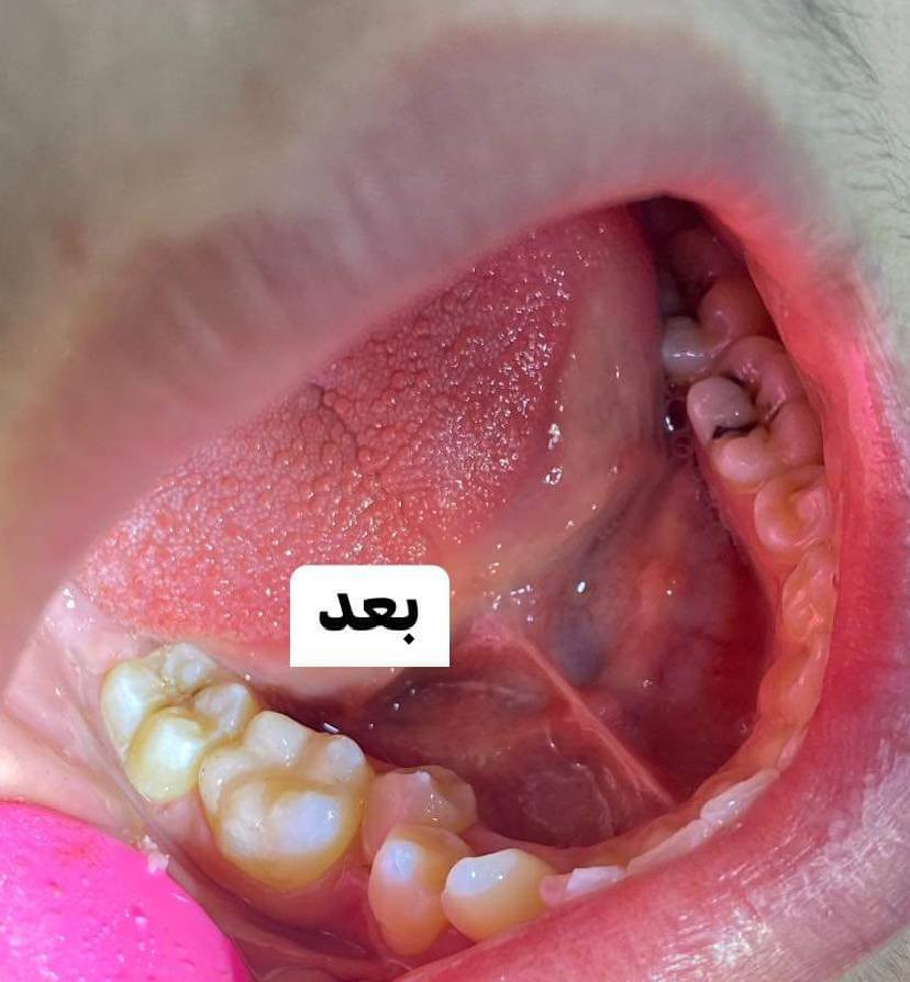 حشوة جذر بجلسة واحده فقط
على يد الطبيب الاختصاص 
الدكتور محمد منصور 
( ماجستير طب ومعالجة الأسنان) 

📍 العنوان :- حي النصر/ شارع السوق/ خلف جامع الأمام المهدي/فوق صيدلية مصطفى جاسم أو اسواق الزعيم 
***********
عيادة الفرح لطب وتجميل الأسنان
