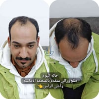 ✔️ تم تصميم خط أمامي طبيعي حسب شكل الوجه ✔️ توزيع البصيلات بكثافة مدرو...