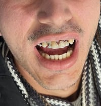 زركون ألماني • عيادة حي النصر • ضمان مدى الحياة