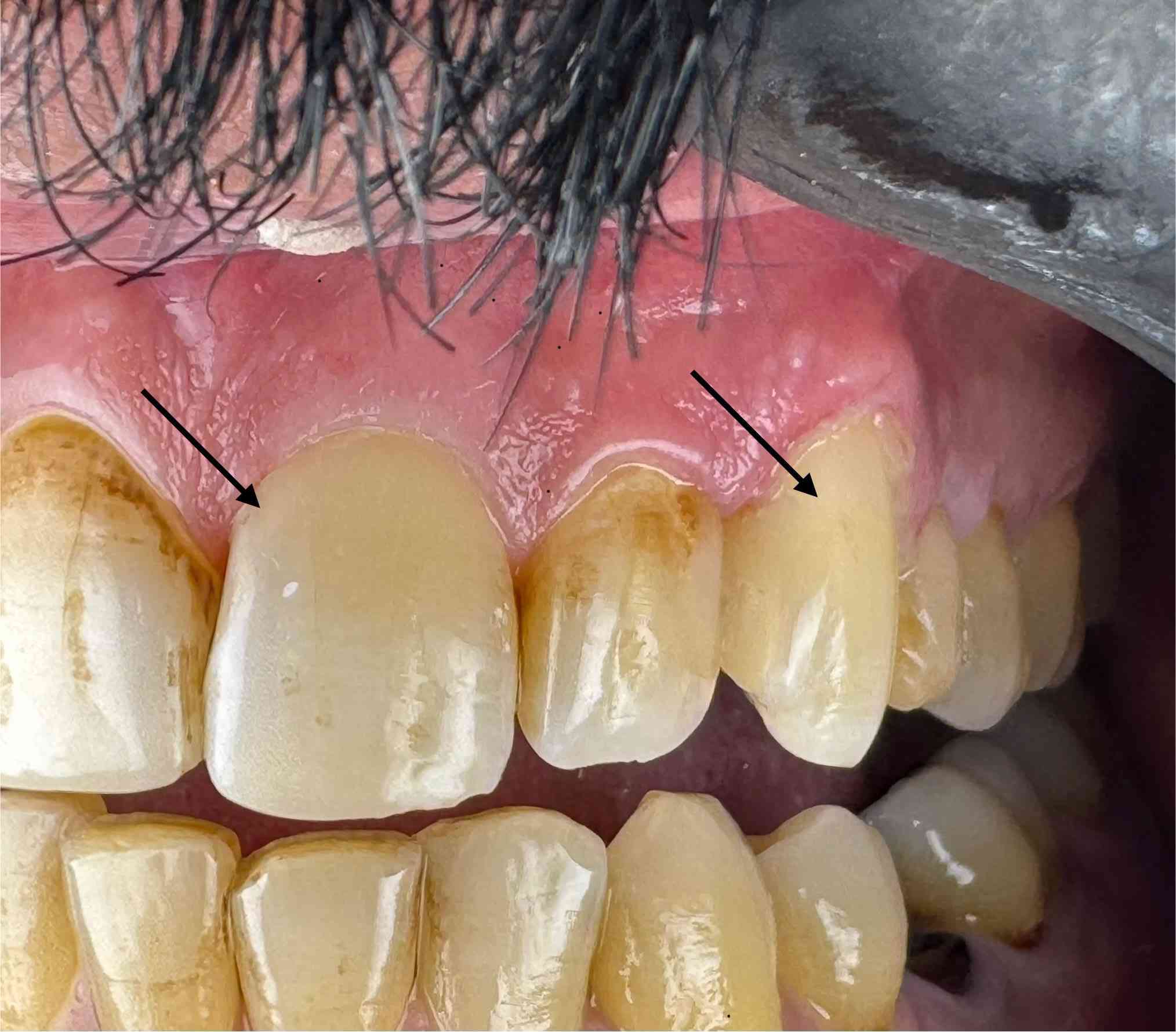 عمل حشوة ضوئية للناب والقاطع 💫

مع تحيات اخوكم د.انور فرحان 🤍

للحجز والاستفسار

***********
