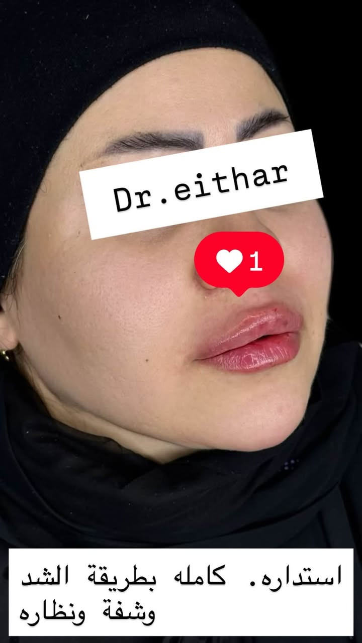 تجديد استداره وجه كامله بطريقة الشد بالفلر (لفتنك وجنات واصداغ  الفك والذقن  ونظاره  فلر شفة بالفلر الكوري)

عروض  خصم التغيير الشامل وجلسات الشد والنظاره    مستمره🔥🔥دزو نقطه توصلكم العروض

د.ايثار سامي عبد الامير
الكوت_واسط _الهوره_مجمع القبطان

الحجز***********
