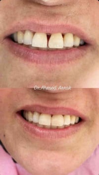 حشوات تجميلية • مطابقة لون • الحسينية