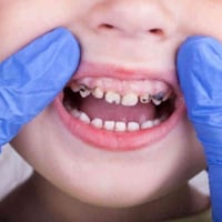 اسنان اطفال • عيادات جامعة واسط • ٥-١٢سنة