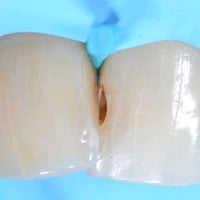 علاج اسنان مجاني • كربلاء حي النقيب • حشوات