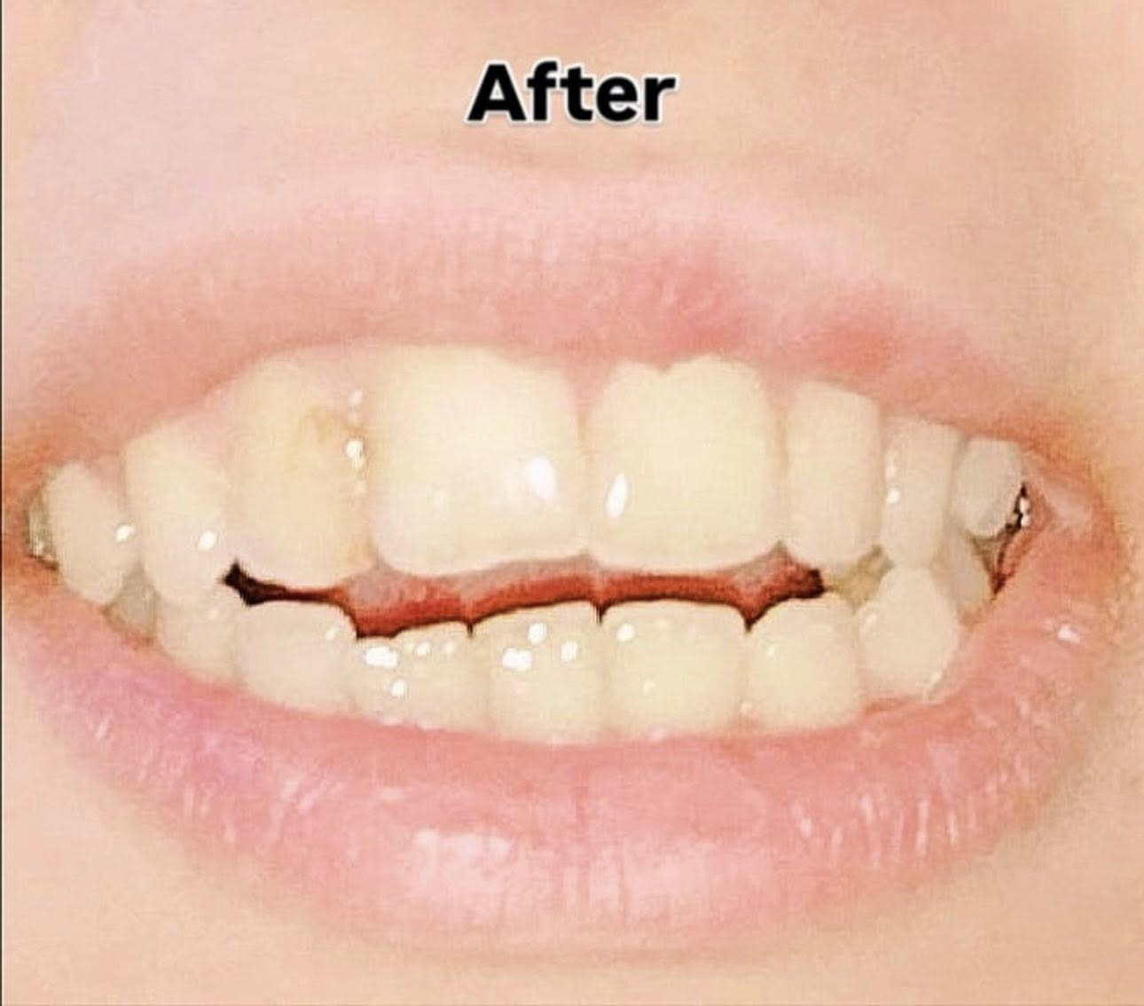✨ علاج أسنان مجانًا وبإشراف أطباء اختصاص ✨
السلام عليكم 
• حشوات ضوئية للأسنان الأمامية والخلفية
 • قلع الأسنان المتحركة والتالفة
 • تنظيف وتلميع الأسنان
 • تعويضات جزئية متحركة
 • كل الشغل يتم بإشراف دكاترة اختصاص من الجامعة لضمان أفضل نتيجة

📍 الموقع: جامعة أوروك – كلية طب الأسنان – شارع 52 / الكرادة
📅 المواعيد: يوم الأحد والاثنين
😊 خلي ابتسامتك ترجع بثقة

📞 للتواصل: ***********
