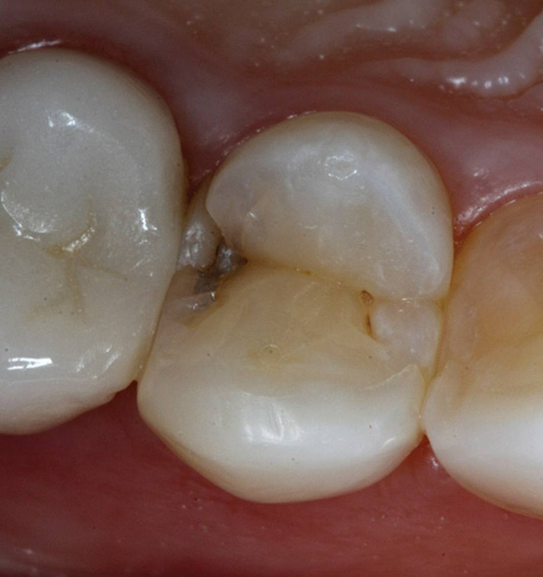 مرحبا منو عنده هيج تسوسات ومحتاج يحشيهن يتواصل ويايه خاص او واتس *********** العلاج مجاني وباشراف اطباء اختصاص داخل عيادات الجامعة المستنصرية
