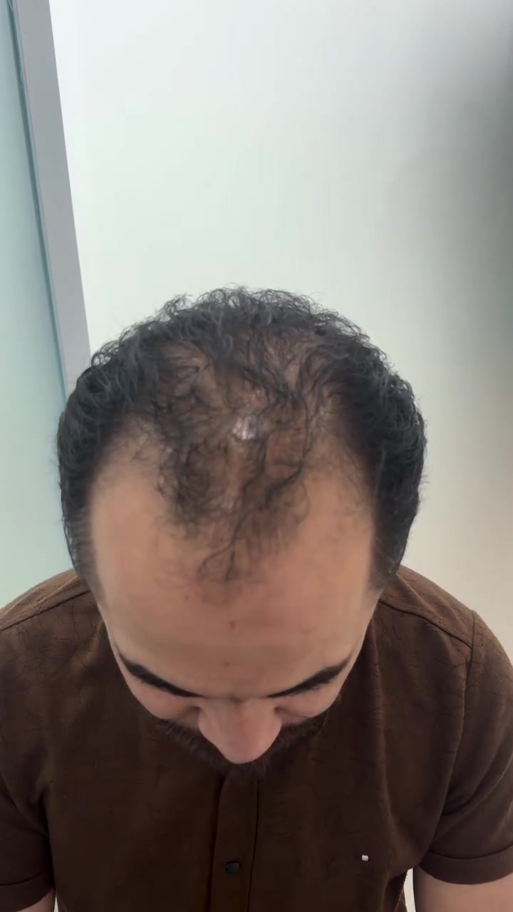 زرع6000 بصيلة شعر بجلسة وحدة، يغطي الصلع والفراغات بالكامل!تقنيات حديثة ودقة عالية تخلي شعرك يرجع طبيعي وكثيف مثل زمان.أنت ازرع، وإحنا نضمنلك أفضل نتيجة!🔥 عروض ولا أروع، وأقساط عالرافدين بدون مقدمة وباستقطاع شهري يناسبك!📞 للحجز والاستشارة: ***********📍 بغداد
