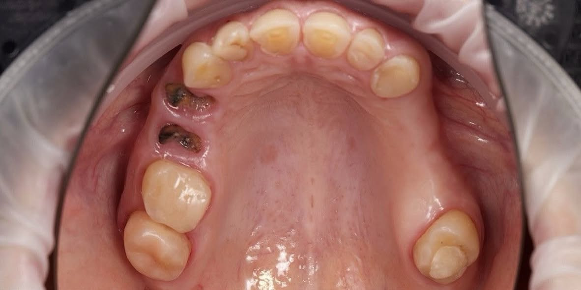 السلام عليكم
الي عنده مثل هالحالات ويحتاج علاج الهم  
حشوات 
تنظيف 
قلع 
طقم أسنان جزئي 
يتواصل وياي: التليگرام  
@hawraa_ahmed9  
واتساب:***********
📍العنوان: الحلة_ شارع ٤٠ مجاور صيدلية سلامتك .
والعلاج مجاااني
