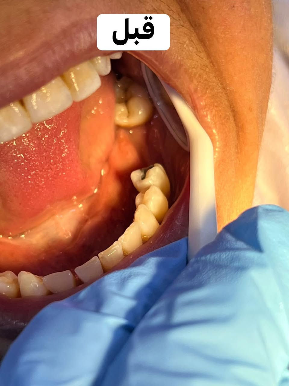 السلام عليكم 
رجعت انفتحت الحجوزات عند الدكتورة تبارك المشعان 
لتعويض الاسنان المفقوده وبشكل مجاني 100‎%‎ 
وكذلك الحشوات وقلع الاسنان التآلفه وتعويضها 
علقو تم او راسلوني خاص على الماسنجر او على الرقم التالي *********** على الواتساب
علماً الحجز ينغلق يوم الجمعة مساءاً
