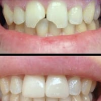 جامعة دجلة الدورة • قلع أسنان • تعويض أسنان