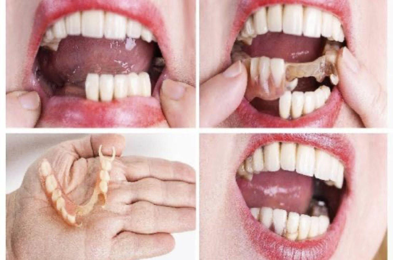 السلام عليكم
اي شخص عنده فقدان باسنانه مثل الحالات الي ناشرتهم جوه وسواء ان كان  الفقدان بأسنانه الامامية او الخلفية 

خلي يراسلني على هذا الرقم 

***********

لأن نگدر نعوض هاذي الاسنان 

علماً ان العلاج مجاني بالكامل
