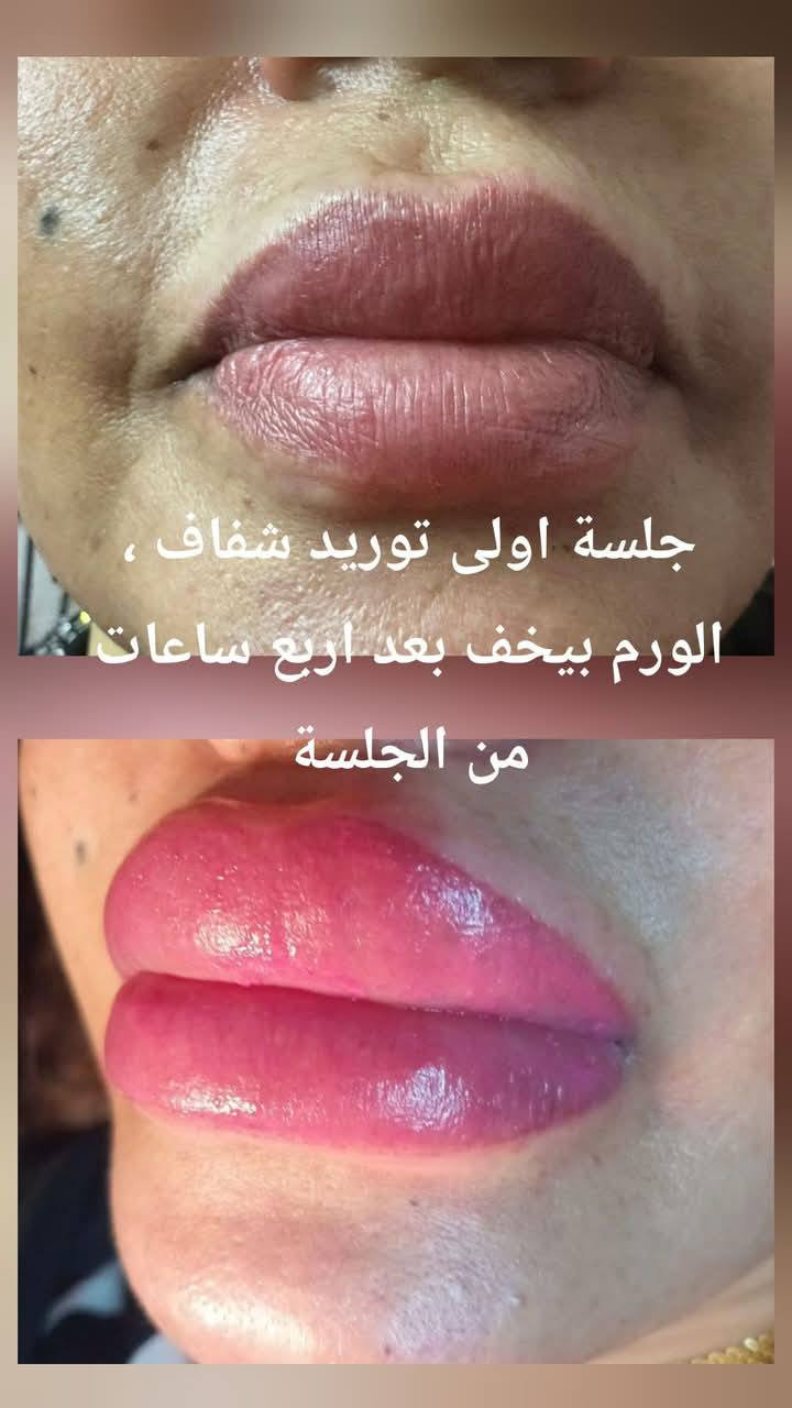 #جلسة_تانية_توريد_شفاف👄
أحلى و أقوى قرار رح تاخديه قبل العيد هوي توريد الشفاف ❤️
لانو العيد أحلى لما تختاري نفسك 🌸
النتيجة رح تكون شفايف وردية ، ثقة أعلى ، وراحة كل يوم بدون ماكياج 😍
للحجز تواصل عالدايركت او عالواتسآب ***********📲

