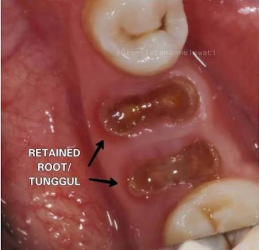 اذا عندكم مثل الحالة بالصور
بقايا اسنان تالفة او اسنان تتحرك 
تتواصلون ويانة على هذا الرقم:  ***********

قلع مجاني وبإشراف اطباء اختصاص
