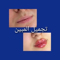جمالك اختيارك  حقن فيلر الشفه باحدث الطرق الطبية  للحجز والاستفسار اتص...