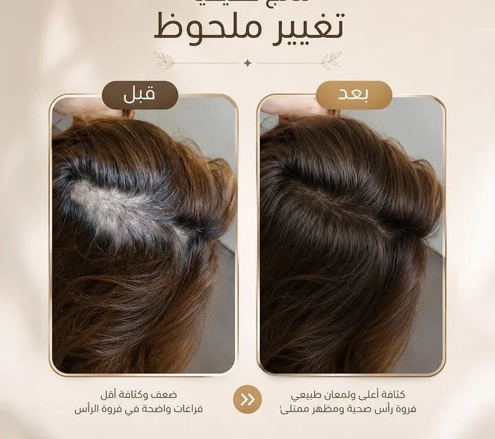 خلال ايام قليله يبين الفرق مع الالتزام بزيت الجوهرة
زيت الجوهرة الاصلي: تخلوا ع شعركم وانتم مأمنين مستحيل يضر شعركم بالعكس هو علاج ومسرح نفس الوقت خالي من المواد الكيميائيه وصنع يدوي ونتأئجه خلال اسبوع واحد يبين فرق للأمانه كلش زين والي يجربة يطلب مره ثانيه 
الزيت تركيبته طبيعية وآمنة، وأنا بنفسي شفت النتيجة اللي تفرح. متوفر حالياً للحجز، لتترددون تطلبوه وتشوفون الفرق بنفسكم! 🤎
للطلب والاستفسار، راسلوا الصفحة مباشرة #زيوت_طبيعية #منتجات_طبيعية


**إذا كنت صاحب هذا الإعلان وتريد حذفه لأي سبب، رجاءا أرسل رسالة إلى الدعم الفني**