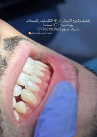 تتوفر لدينا عيادات مجانيه تنظيف وتلميع الاسنان وازالة التكلسات والتصبغ...