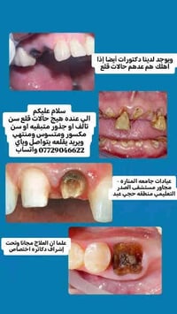 علاج مجاني • قلع اسنان • جامعة المنارة