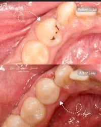 تسوس جانبي • قلع جذور • مجاناً