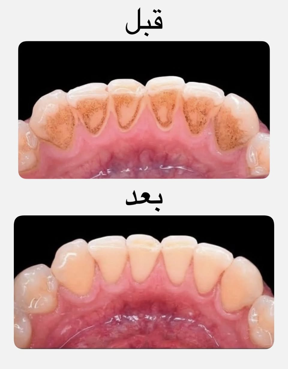 السلام عليكم ورحمة الله

أهالينا في النجف

 اللي يحتاج تنظيف او حشوات تجميلية لاسنانه 

يتواصل وياي على الواتساب ***********او من خلال فيسبوك 

والعمل مجاناً

