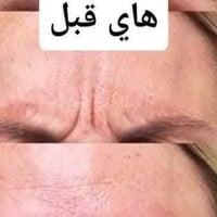 معالج تجاعيد • عرض حصري • كمية محدودة