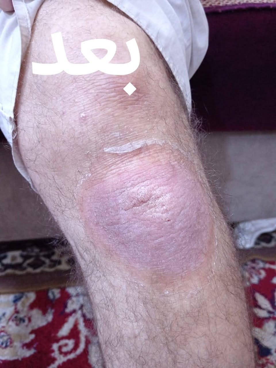 غدآ دوام دكتور خلدون في العيادة العنوان ناحية الشورة داخل القيصرية في الساعة الواحدة والنصف ظهراً ٠٠٠٠ علاج حالة صدفية لمريض بعمر ٧٠ سنة بعد ٧ أيام من العلاج للحجز والاستفسار التواصل عبر الهاتف ***********
