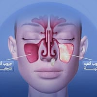 دكتورة فاطمة الصافي • التهاب الجيوب الأنفية • الرميثه شارع الأطباء