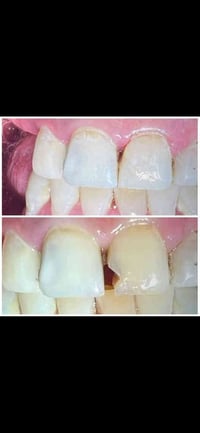 تنظيف اسنان • تكلسات • علاج مجاني