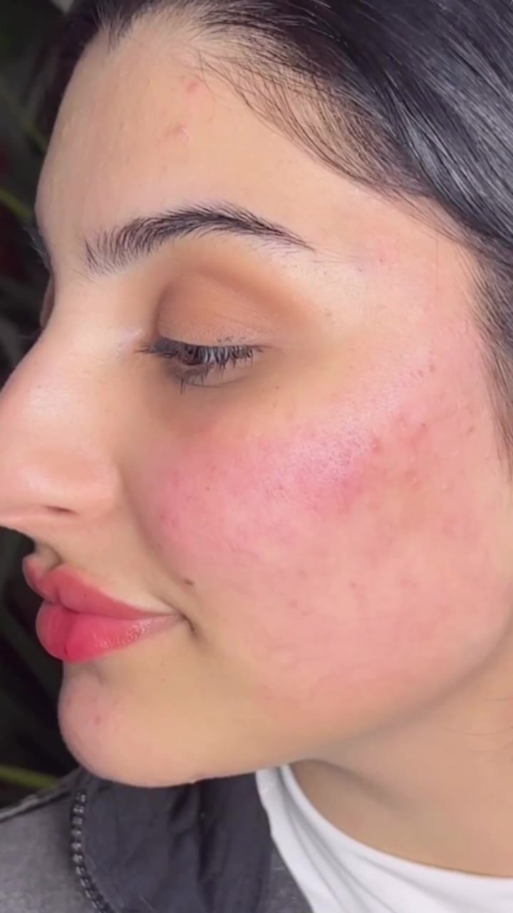 هذه الحالة اشتغلنا على  Full Face Refresh

• الأصداغ والوجنات: لإعطاء رفعة طبيعية (Lift) للوجه وتحديد أجمل.

• الهالات: وداعاً للتعب وشحوب منطقة العين.

• الشفاه: لمسة ناعمة وتحديد يكمل جمال الابتسامة.

النتيجة؟ ملامح مرتاحة، وجه مشرق، وثقة لا توصف. 🤍


**إذا كنت صاحب هذا الإعلان وتريد حذفه لأي سبب، رجاءا أرسل رسالة إلى الدعم الفني**