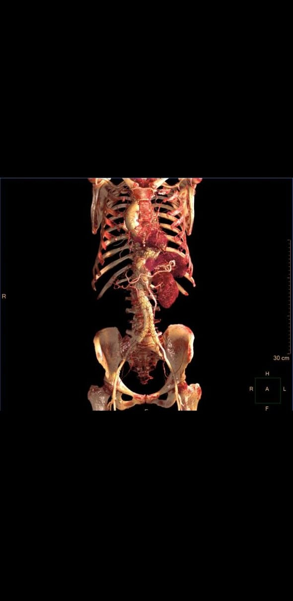 هل تبحث عن أقوى برنامج لتحليل صور الأشعة الطبية؟
نقدم لكم Philips IntelliSpace Portal 12 بأحدث إصدار مع تفعيل لايسنس أصلي وإمكانية التقسيط.

💎 المميزات:

✅ عرض وتحليل صور CT – MRI – PET – NM – Ultrasound
✅ إنشاء صور ثلاثية ورباعية الأبعاد 3D / 4D
✅ تحليل متقدم للأوعية الدموية والقلب
✅ تحليل الأورام والدماغ والرئة والكبد والعظام
✅ سرعة عالية جداً في المعالجة
✅ إمكانية التنصيب على:

💻 لابتوب
🖥️ حاسوب مكتبي
🖥️ Workstation احترافي
🖥️ Server + Client

🔐 الخدمات المتوفرة:

✔️ تفعيل لايسنس أصلي
✔️ تنصيب كامل وضبط الإعدادات
✔️ تشغيل جميع التطبيقات
✔️ دعم فني كامل

💳 إمكانية التقسيط متوفرة

📍 مناسب للمستشفيات ومراكز الأشعة

📞 ***********
📍 بغداد – خدمة جميع المحافظات

---

Looking for the most powerful medical imaging analysis software?
We provide Philips IntelliSpace Portal 12 with Original License Activation and Installment Plans Available.

💎 Features:

✅ Advanced DICOM Viewer for CT, MRI, PET, NM, and Ultrasound
✅ High-performance 3D / 4D visualization
✅ Advanced Vessel and Cardiac Analysis
✅ Oncology, Brain, Lung, Liver, and Bone Applications
✅ Ultra-fast image processing
✅ Can be installed on:

💻 Laptop
🖥️ Desktop Computer
🖥️ Professional Workstation
🖥️ Server + Client

🔐 Services Included:

✔️ Original License Activation
✔️ Full Installation and Configuration
✔️ All Clinical Applications Enabled
✔️ Full Technical Support

💳 Installment Available this method only in iraq

📞 +964 750 254 2418
📍 Baghdad – Service Available Across Iraq

---

#Philips
#IntelliSpacePortal
#Portal12
#Radiology
#MedicalImaging
#PACS
#DICOM
#Paxi_iq
#Baghdad
