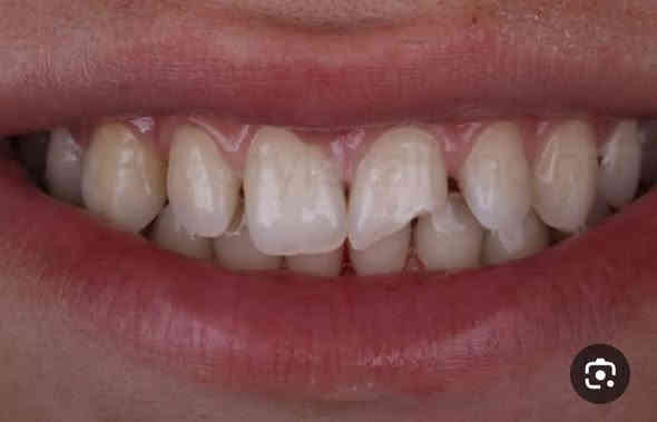 السلام عليكم الي محتاج حشوات مجانيه
مثل هيج حالات اتصال  على ***********
