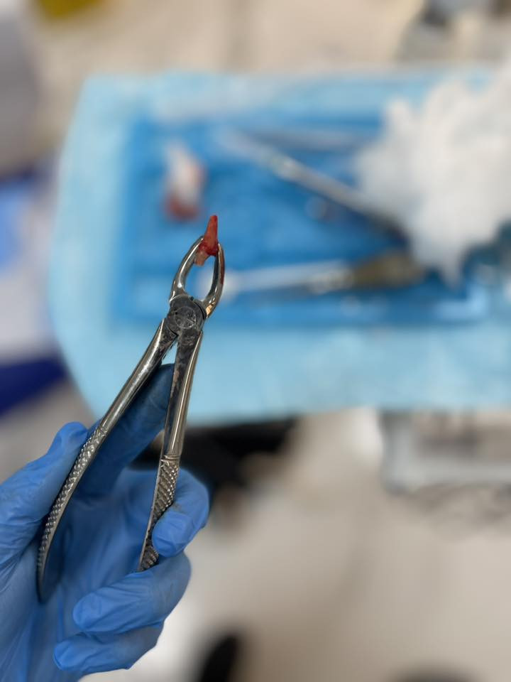 اي احد عنده جذور باقيه بأسنانه او عنده سن يريد يقلعه يتواصل وياي على الخاص او على هذا الرقم 
*********** القلع مجاناً العنوان جامعه العين  تحت اشراف اطباء اختصاص
