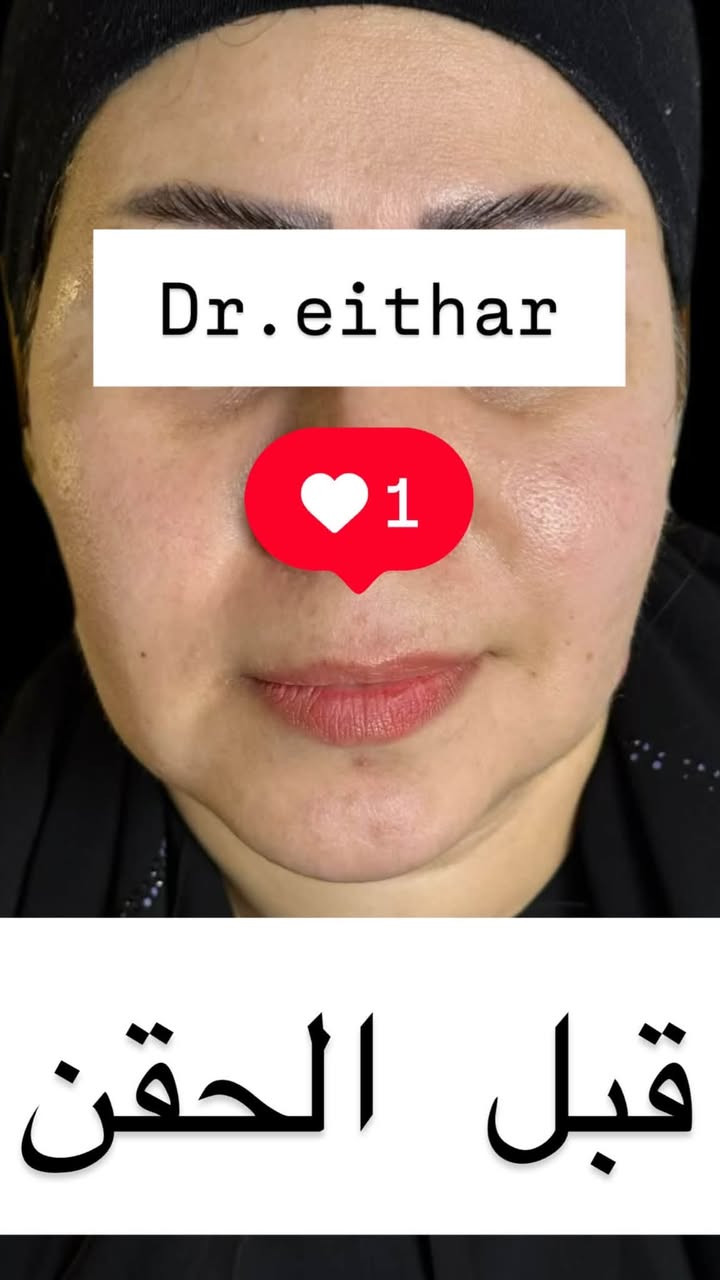 تجديد استداره وجه كامله بطريقة الشد بالفلر (لفتنك وجنات واصداغ  الفك والذقن  ونظاره  فلر شفة بالفلر الكوري)

عروض  خصم التغيير الشامل وجلسات الشد والنظاره    مستمره🔥🔥دزو نقطه توصلكم العروض

د.ايثار سامي عبد الامير
الكوت_واسط _الهوره_مجمع القبطان

الحجز***********
