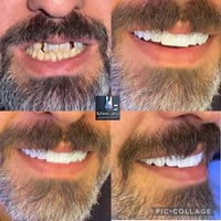 بالتقسيط • زيركون 7D • خصم٥٠٪