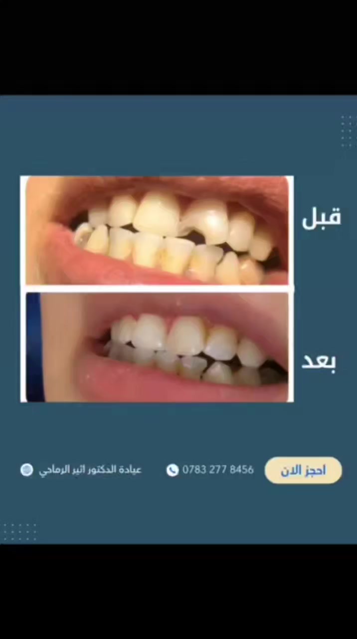 عمل حشوات تجميلية للأسنان الاماميه بدقه عاليه للمظهر طبيعي ومتناسق

(عياده الدكتور اثير حليم الرماحي)

📍الموقع: 
الديوانية- قضاء عفك/شارع الأطباء قرب صيدلية أكرم البديري بناية الدكتورة مروة حمود التميمي الطابق الثاني

☎️لحجز موعد: [***********]

#ابتسامتك_تستحق_الأفضل
 #طب_اسنان  #دکتور_اسنان
#قضاء_عفك #اكسبلور
