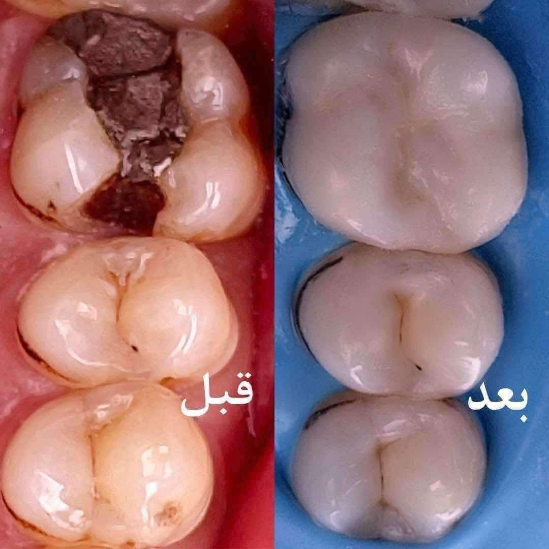 🔵🔵 عيادات النخبة 🔵🔵
د. نور صبيح صالح متمرّس في طب الأسنان وخبرة اكثر من سنتين في المجمعات الطبية (مجمع السلام الطبي و مجمع الواعظ الطبي) 

🔴حشوات الاسنان الضوئية

🔴تعويض الأسنان المفقودة

🔴قلع الأسنان التالفة والجذور

🔴تنظيف الأسنان من التكلسات والتصبغات

🔴معاينة وعلاج امراض والتهابات الفم (اللثة واللسان)

🔴تقويم للاطفال

🔴علاج اسنان الاطفال

 (تنظيف - حشوات - جلسات حماية من التسوس - قلع)

المعاينة والعلاج باحدث الاجهزة والمواد وخصيصآ قسم الحشوات براندات عالمية مثل ماركة GC و ماركة 3M
وموجودة دكتورة اسنان للعوائل المحافظة

العنوان : المنصور مقابل مستشفى الهلال الاحمر

التواصل والإستفسار :

***********
