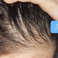 زيت شعر • يوقف تساقط • تفتيح وجه