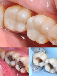 حشوات ضوئية • ترميم كامل السن • مجمع اليمامه