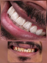 تجميل اسنان • مركز بسماية • بغداد